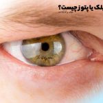 An example of eyelid drooping or ptosis