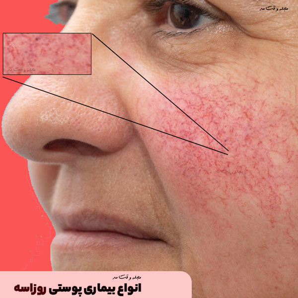There are 4 types of rosacea skin disease
