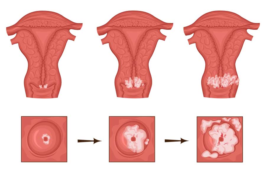 PAP Smear Screening