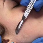 What is dermaplaning?
