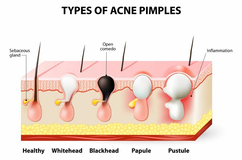 The scientific reason for blackheads