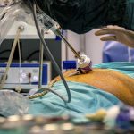 Gastric sleeve surgery