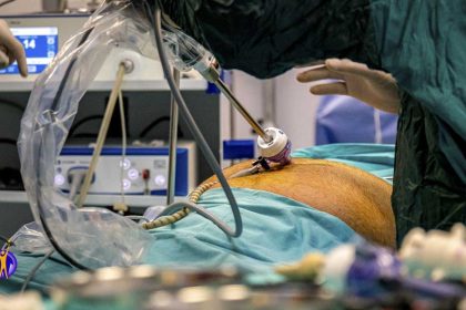 Gastric sleeve surgery