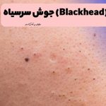 An example of facial blackheads