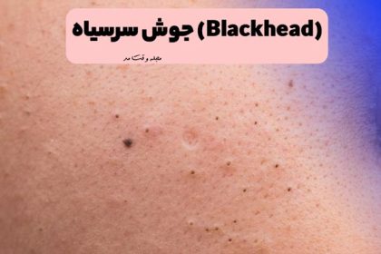An example of facial blackheads