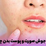 A picture of severe acne on the chin