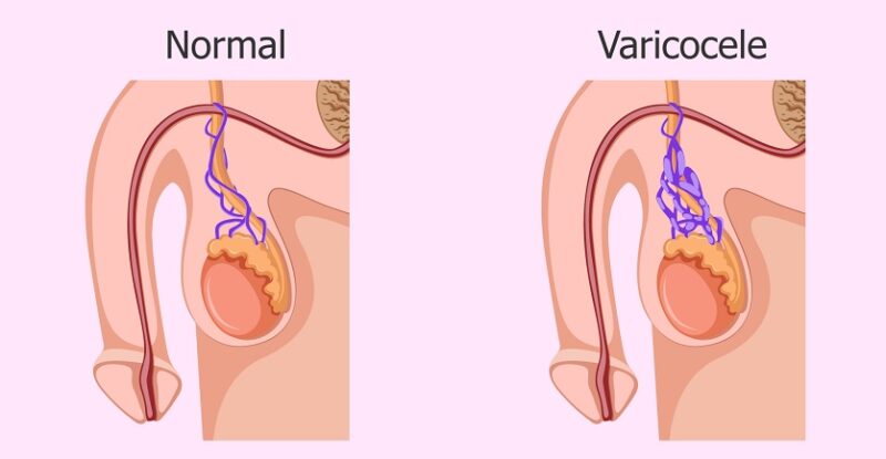 Does varicocele surgery cause infertility?