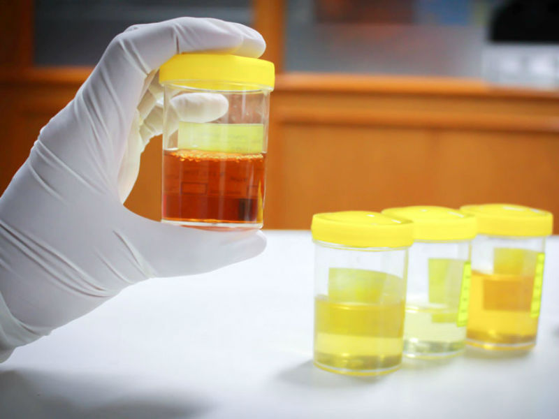 Treatment of blood in men's urine