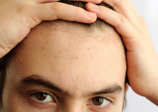 What is a pimple on the forehead?