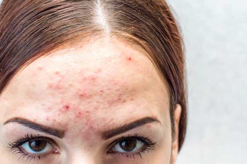 The cause of forehead acne in women 