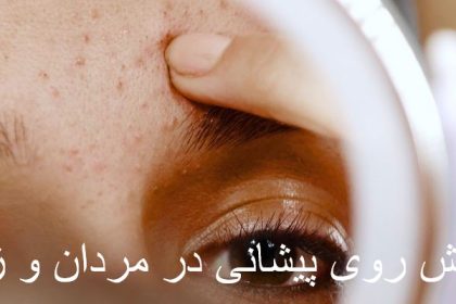 What is a pimple on the forehead?