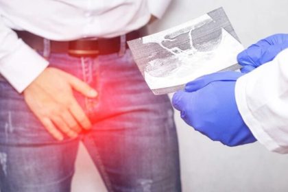 Complications of varicocele in marital relationship