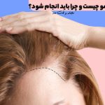 hair mesotherapy; It is a treatment method that is performed by injecting vitamins, minerals and a mixture of amino acids needed by the scalp.