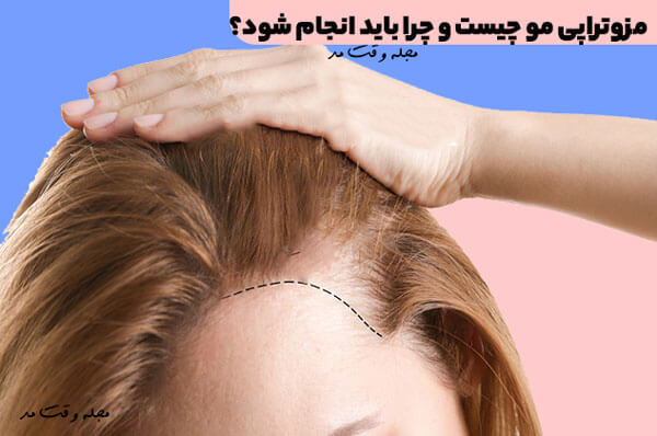 hair mesotherapy; It is a treatment method that is performed by injecting vitamins, minerals and a mixture of amino acids needed by the scalp.