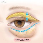 Causes and home remedies for puffiness under the eyes