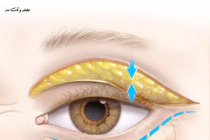 Causes and home remedies for puffiness under the eyes