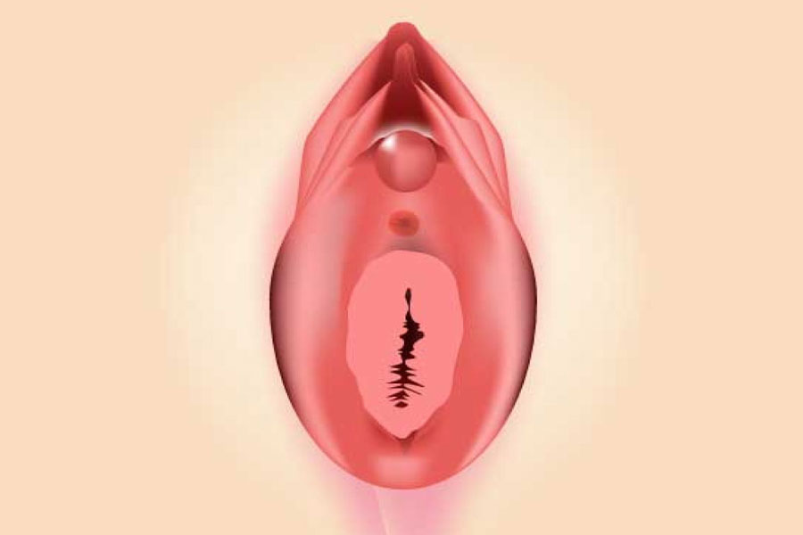 Hymen rupture repair