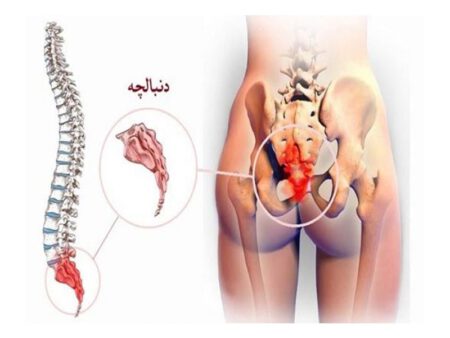 Home remedies for coccyx pain in women