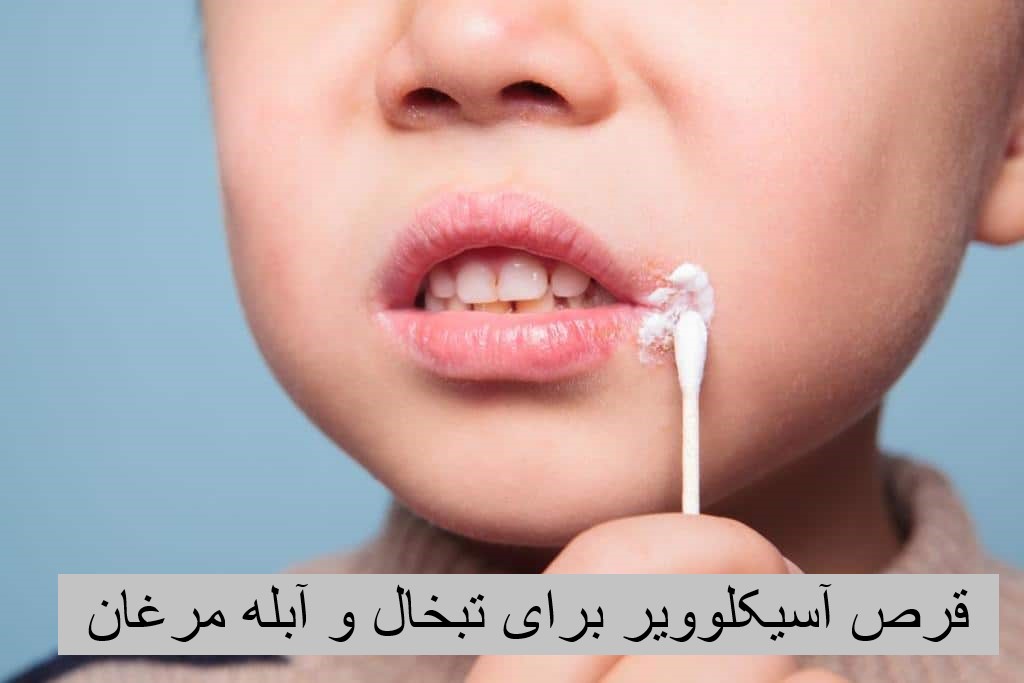 Acyclovir 400 tablets for herpes and chicken pox