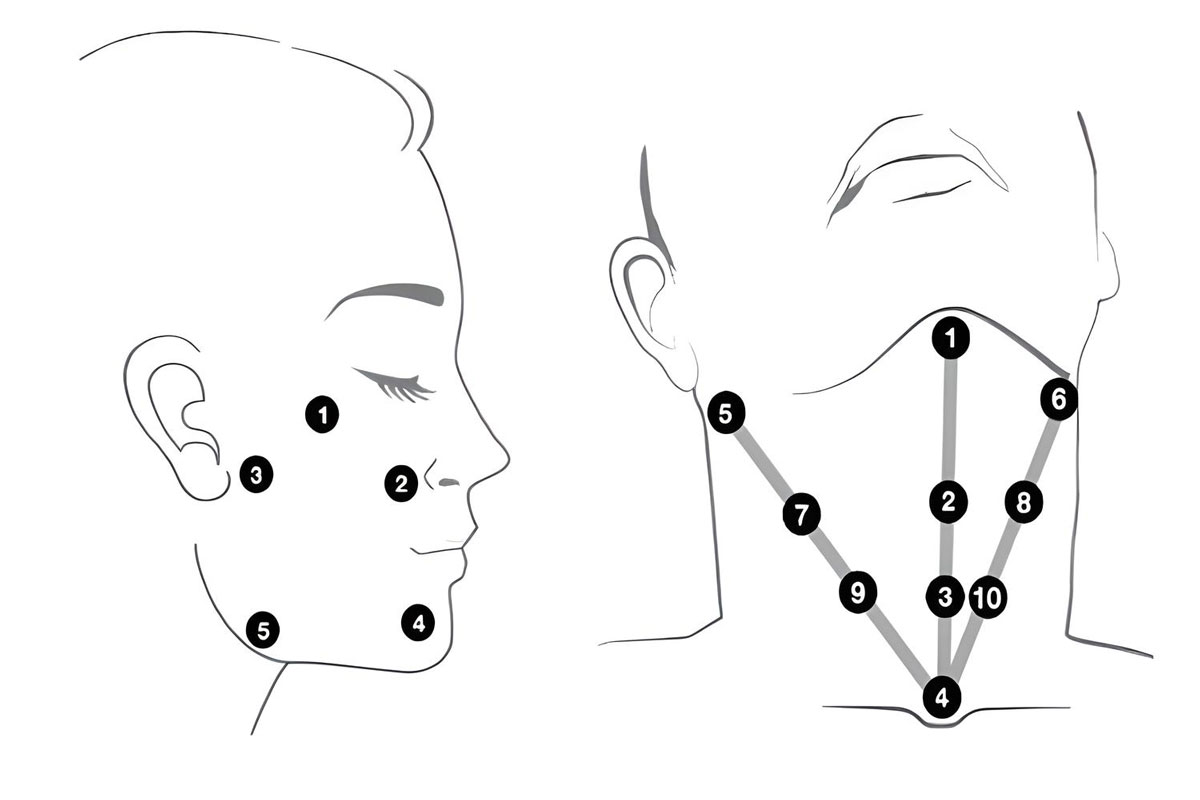 The main injection points of Profilo in the face