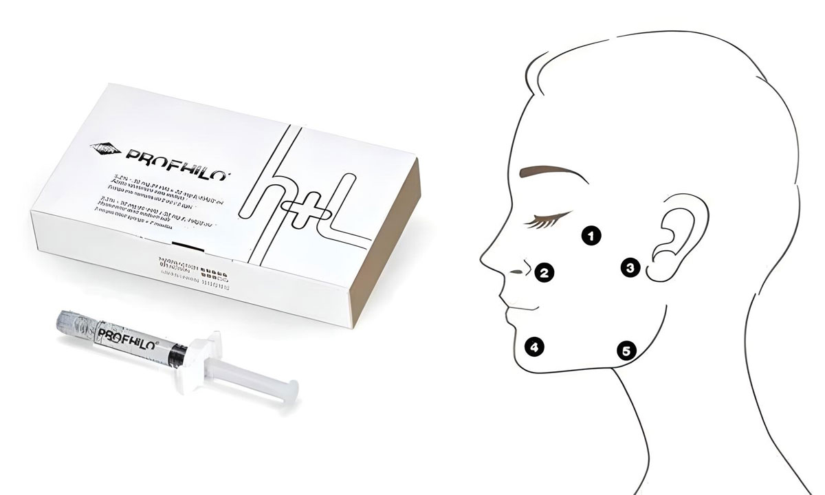 Profile injection points