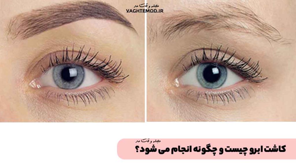 What is eyebrow transplant?