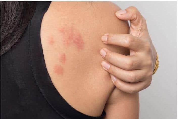 Fastor pill for urticaria