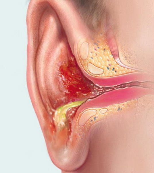 The best drops for adult ear infections