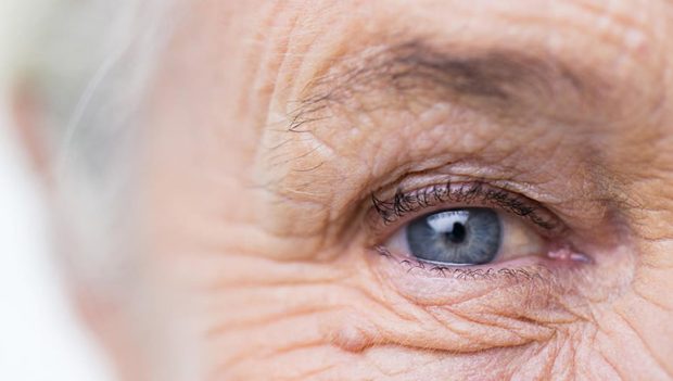 Age -related macular degeneration