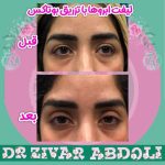 Eyebrow lift with Botox injection