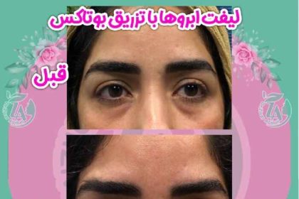 Eyebrow lift with Botox injection