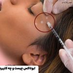 Botox temporarily paralyzes the muscles.