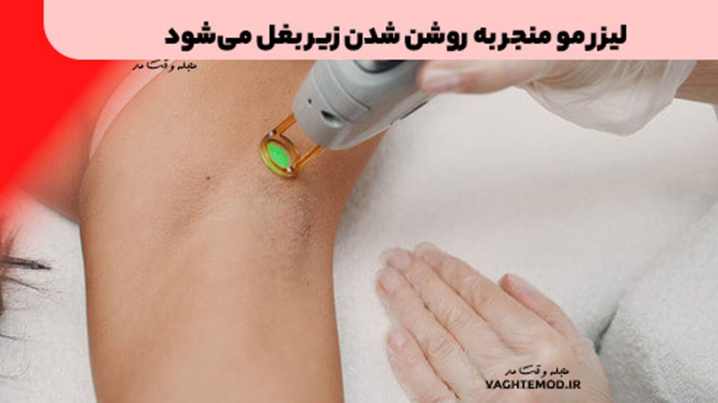 Laser of the hair leads to the armpit on the armpit