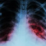 Video/ Increased TB after Corona; Children are at risk