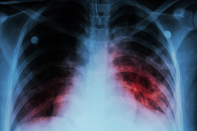 Video/ Increased TB after Corona; Children are at risk