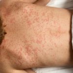 Video/ Increases the Prevalence of Measles in America; ۱ Staters clashed