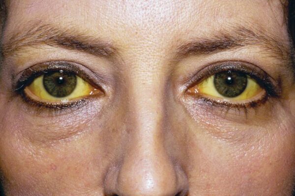 What to eat for jaundice?