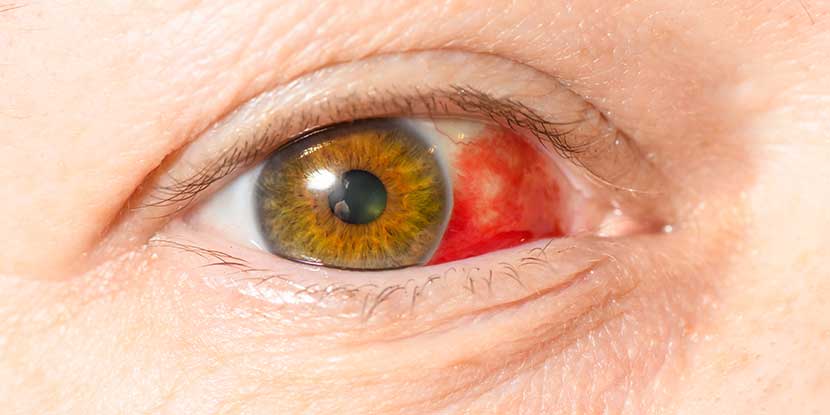Treatment of blood stain in the eye due to impact