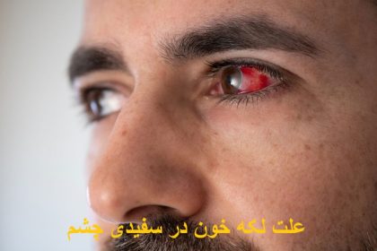 The cause of blood stain in the white eye