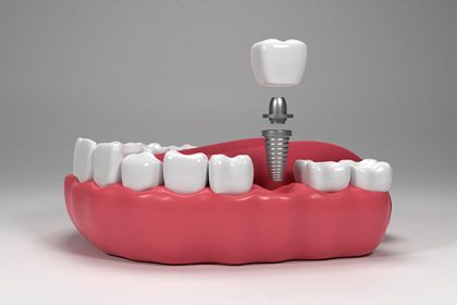 Types of Dental Implant Brands