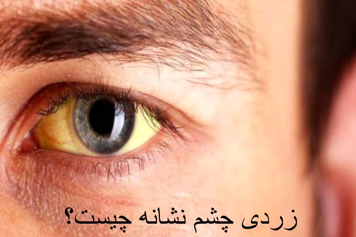 What is a sign of yellowing?