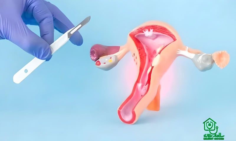 Vaginal narrowing operation