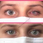 Eye color correction without surgical