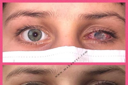 Eye color correction without surgical