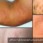 What can we eat for the treatment of urticaria? The best pill and ampoules for the treatment of urticaria + home therapy