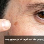 What is the sign of black spots on the face and body of the face? Treatment of black spots on the skin