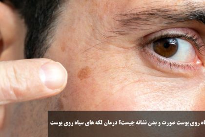 What is the sign of black spots on the face and body of the face? Treatment of black spots on the skin