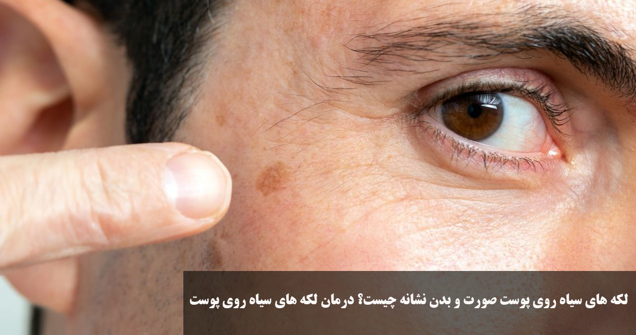What is the sign of black spots on the face and body of the face? Treatment of black spots on the skin