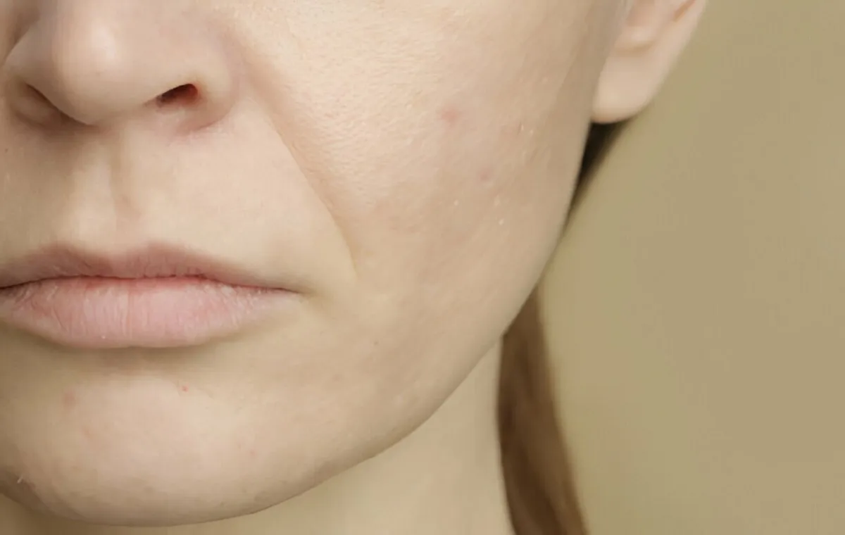 Facial brown spots