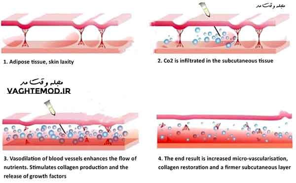 How does carboxy therapy work?